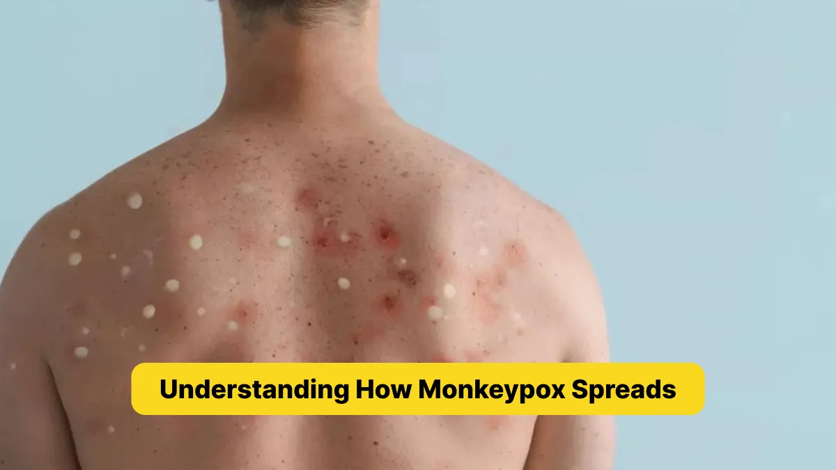 Understanding How Monkeypox Spreads